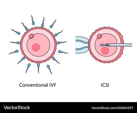 Diagram porovnania IVF a ICSI