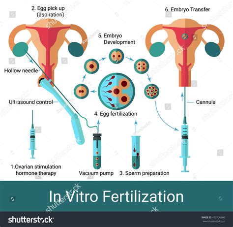 Schéma procesu IVF (In Vitro Fertilization) - odber vajíčok, oplodnenie v laboratóriu, kultivácia embryí a embryotransfer