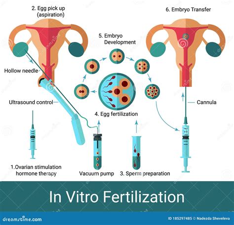 Schéma procesu In Vitro Fertilization (IVF)