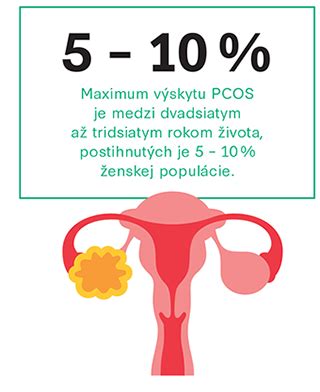 Infografika príznakov syndrómu polycystických ovárií (PCOS)