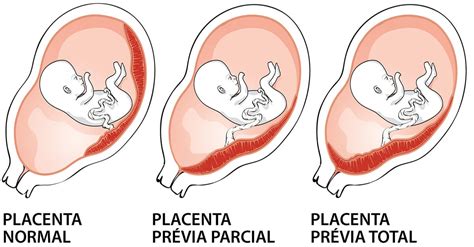 Placenta na prednej stene maternice