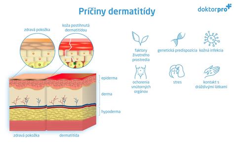 Ilustrácia prejavov plienkovej dermatitídy