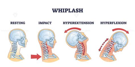 Diagram mechanizmu whiplash zranenia
