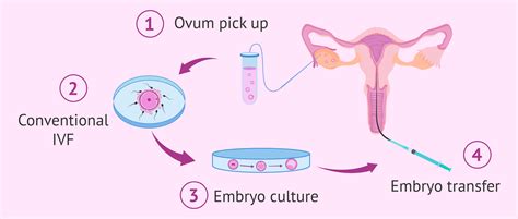 Schéma umelého oplodnenia (IVF)