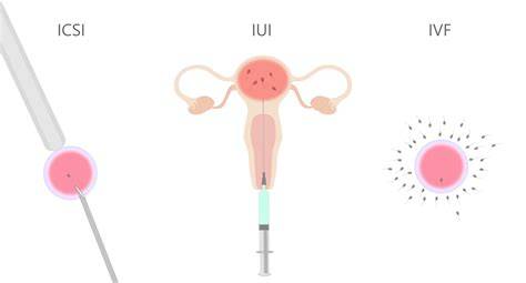 Schéma metód asistovanej reprodukcie (IVF, IUI, ICSI)