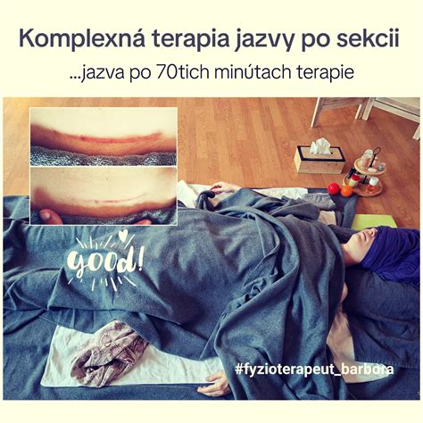 Ilustrácia hojenia jazvy po cisárskom reze