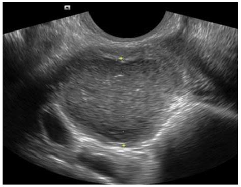Pohľad na maternicu s hyperplastickým endometriom