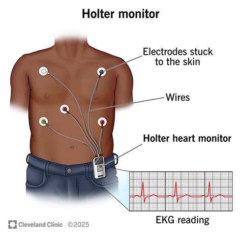 EKG Holter monitor