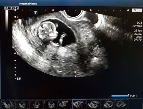Tehotenský ultrazvuk so zobrazením embrya a žĺtkového vačku