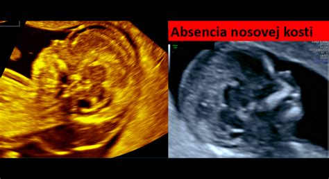 Zobrazenie plodu na ultrazvuku v prvom trimestri