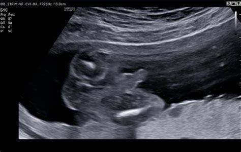 Detailné zobrazenie tváre plodu na ultrazvuku