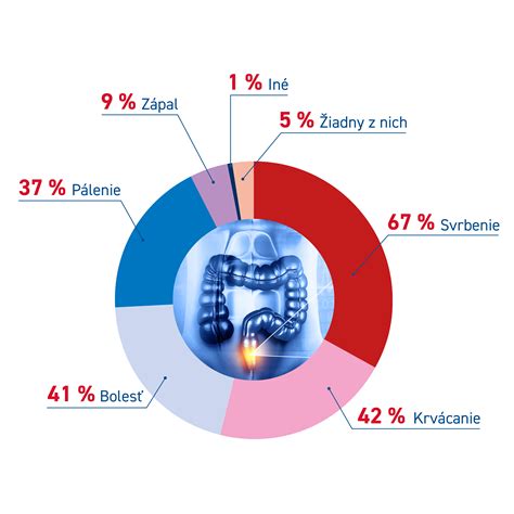 Infografika zobrazujúca rôzne štádiá hemoroidov a ich symptómy
