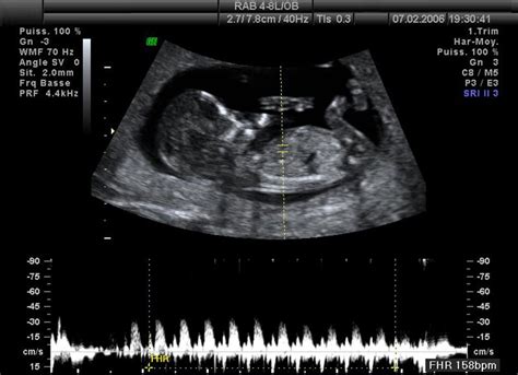 ultrazvuk plodu v 20 týždni