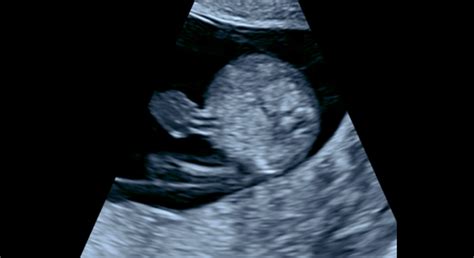 Ultrasonografický obraz plodu v druhom trimestri
