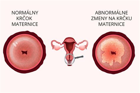 Diagram zobrazujúci dilatáciu krčka maternice