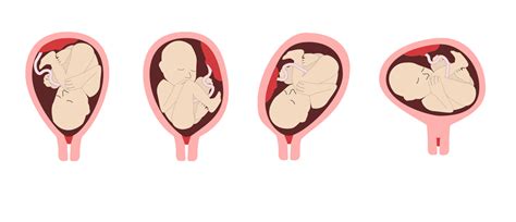 Infografika zobrazujúca rôzne polohy plodu v maternici