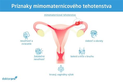 Schematický nákres ženského reprodukčného systému s vyznačenými možnými miestami mimomaternicového tehotenstva