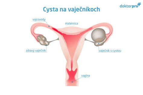 Infografika rôznych typov cýst na vaječníkoch
