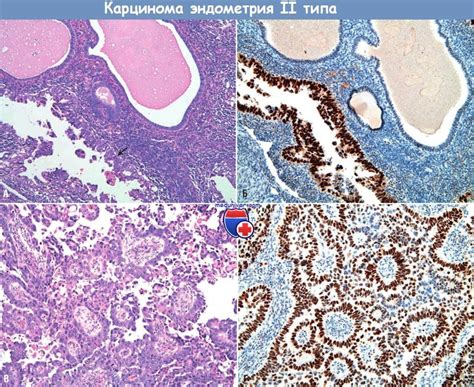 Diagram porovnávajúci typ I a typ II karcinómu endometria