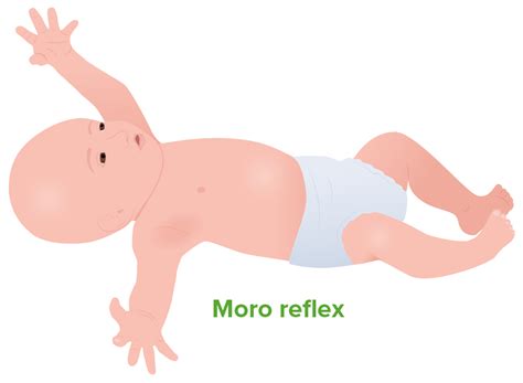 Diagram zobrazujúci Moro reflex