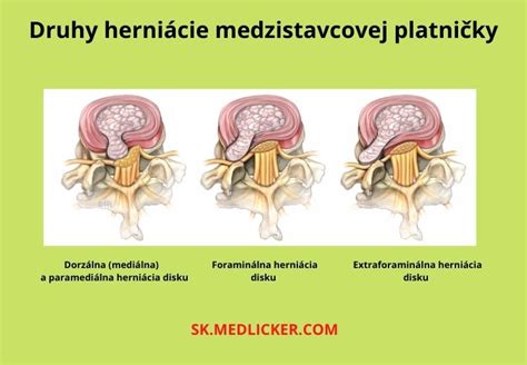 Zobrazenie medzistavcovej platničky s herniou