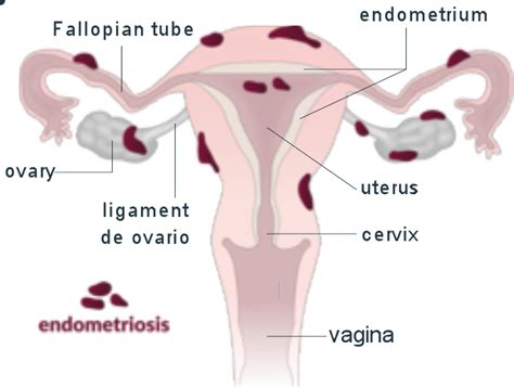 Ilustrácia výskytu endometriózy