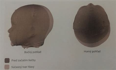 Porovnanie tvarov hlavy pri kraniostenóze a zležanej hlavičke