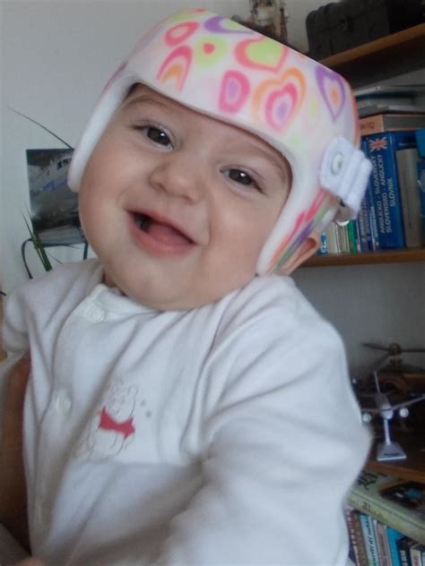 Ilustrácia dieťaťa s kraniálnou ortézou