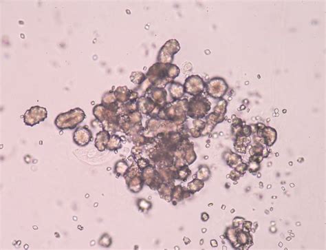 Ilustrácia znázorňujúca kryštály kyseliny močovej v kĺbe