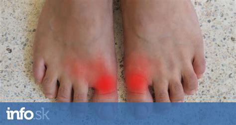 Ilustrácia znázorňujúca opuchnutý a začervenaný kĺb palca na nohe