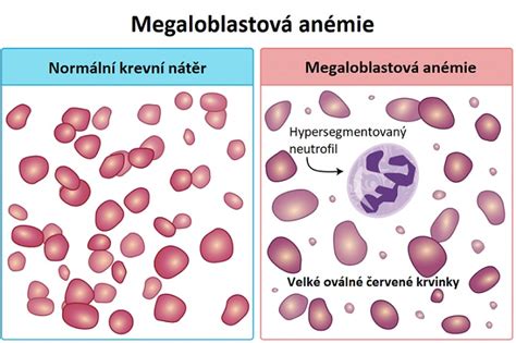 Schéma rozkladu červených krviniek a tvorby bilirubínu