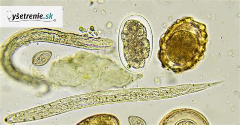 Infografika zobrazujúca bežné príznaky parazitárnych infekcií u detí