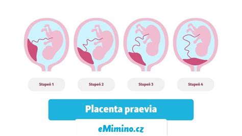 infografika o typoch placenty praevia