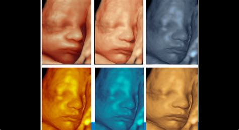 3D ultrazvukové zobrazenie tváre plodu v druhom trimestri