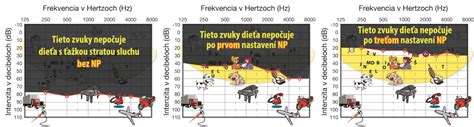 Infografika znázorňujúca rôzne typy načúvacích prístrojov a FM systému
