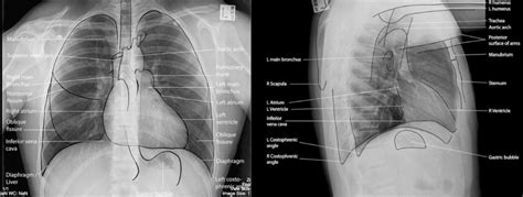 RTG snímka pľúc s viditeľným zápalom pľúc