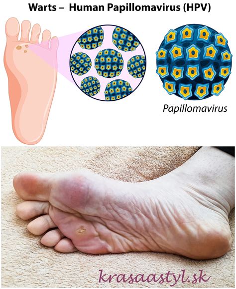 Ilustrácia žíl na nohe