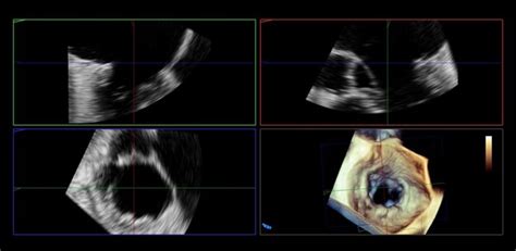 ultrazvukové zobrazenie srdca embrya