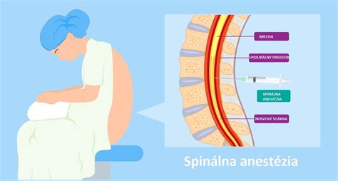 Infografika porovnávajúca spinálnu a epidurálnu anestéziu