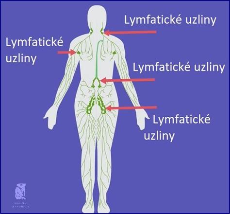 Ilustrácia zväčšenej uzliny pri zápale