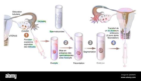 schéma procesu in vitro fertilizácie