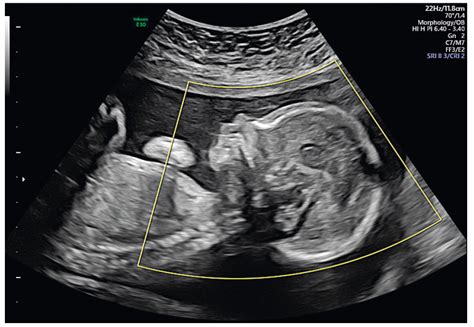 Grafické znázornenie 4D ultrazvukového zobrazenia plodu
