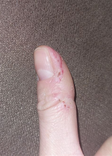 Detail rúk dieťaťa, ktoré má tendenciu obhrýzať si kožu okolo nechtov