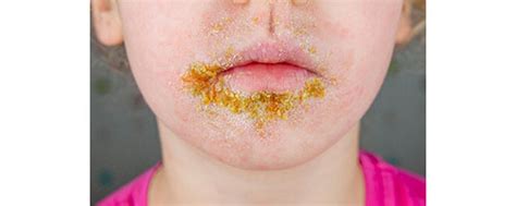 Zobrazenie rôznych štádií impetiga na detskej pokožke, od začervenania po medové krusty