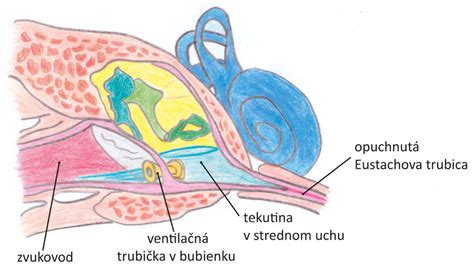 Diagram znázorňujúci Eustachovu trubicu a jej súvis s infekciami uší
