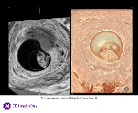 Ilustrácia postupu pri gynekologickom vyšetrení a ultrazvukovej diagnostike