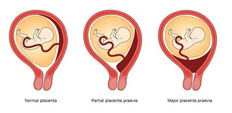 Placenta praevia a jej typy (marginalis, partialis, totalis)