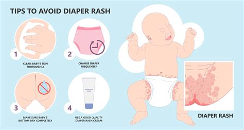 Diaper Rash Prevention and Treatment