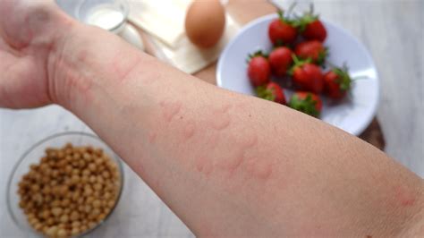 Schéma alergickej reakcie