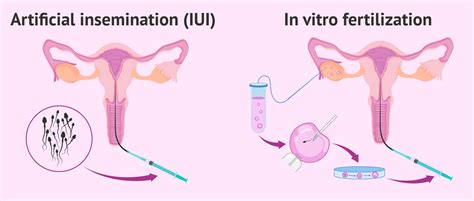 Schéma: Rozdiel medzi IVF a IUI